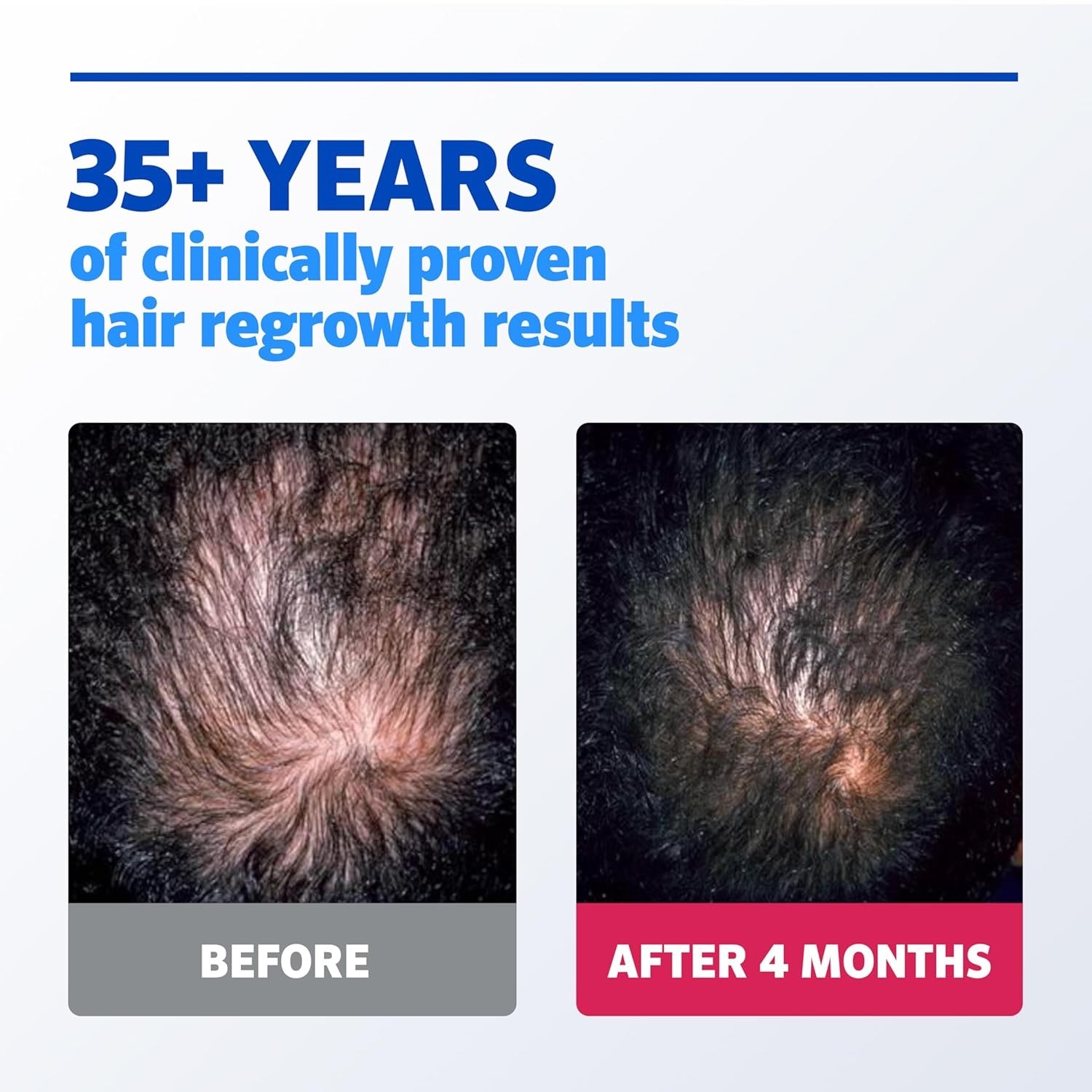✳️ Kirkland Minoxidil 5% Extra Strength Men Hair Regrowth Treatment 6 Supply ✳️