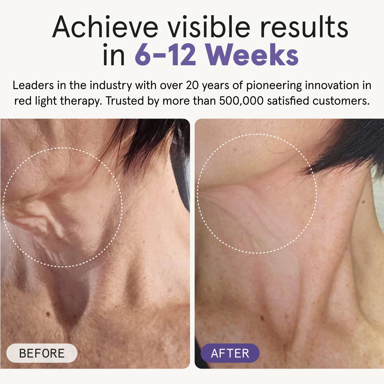 iRESTORE Illumina Neck & Chest Mask- Reconditioned