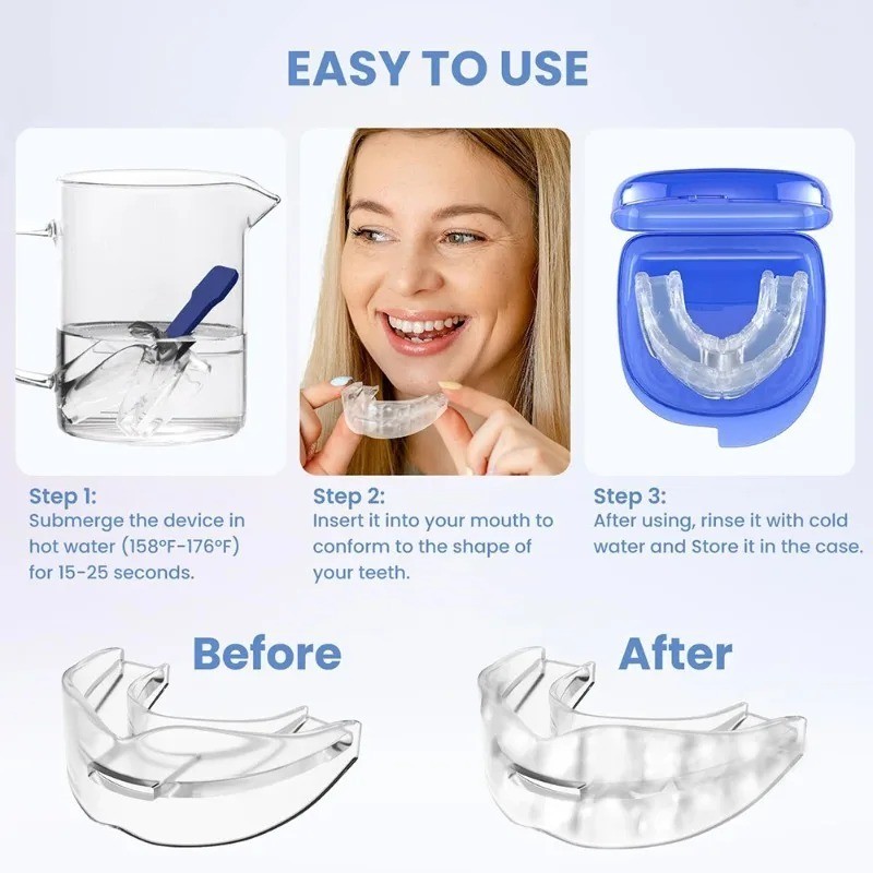 Honex Anti Snoring Mouthpiece Reduce Snoring Aid, Snore Solution for Comfort
