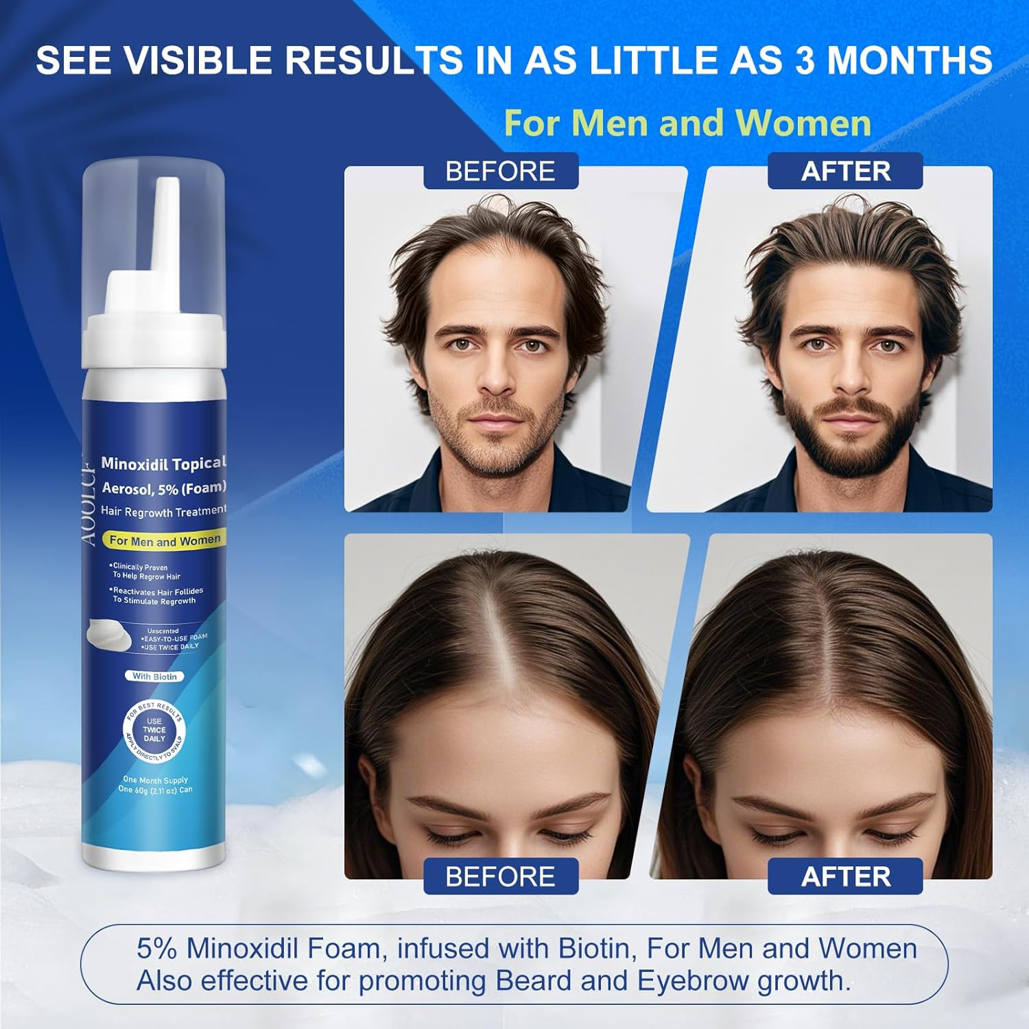 5% Topical Minoxidil Foam Minoxidil for Men and Women Infused with Biotin