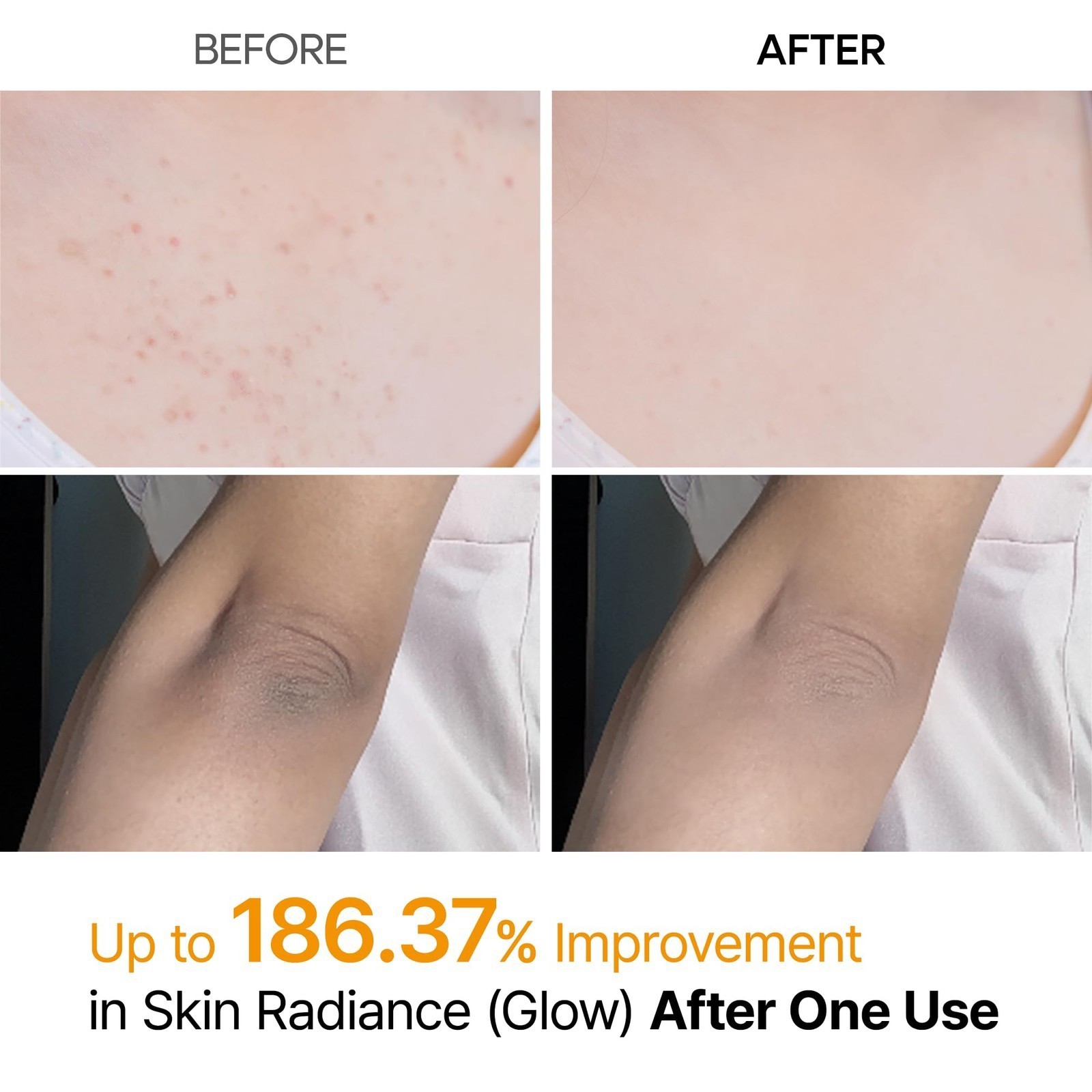 Body Keratin Care Kojic Acid Turmeric Spray Gently Exfoliating Peeling Soluti…