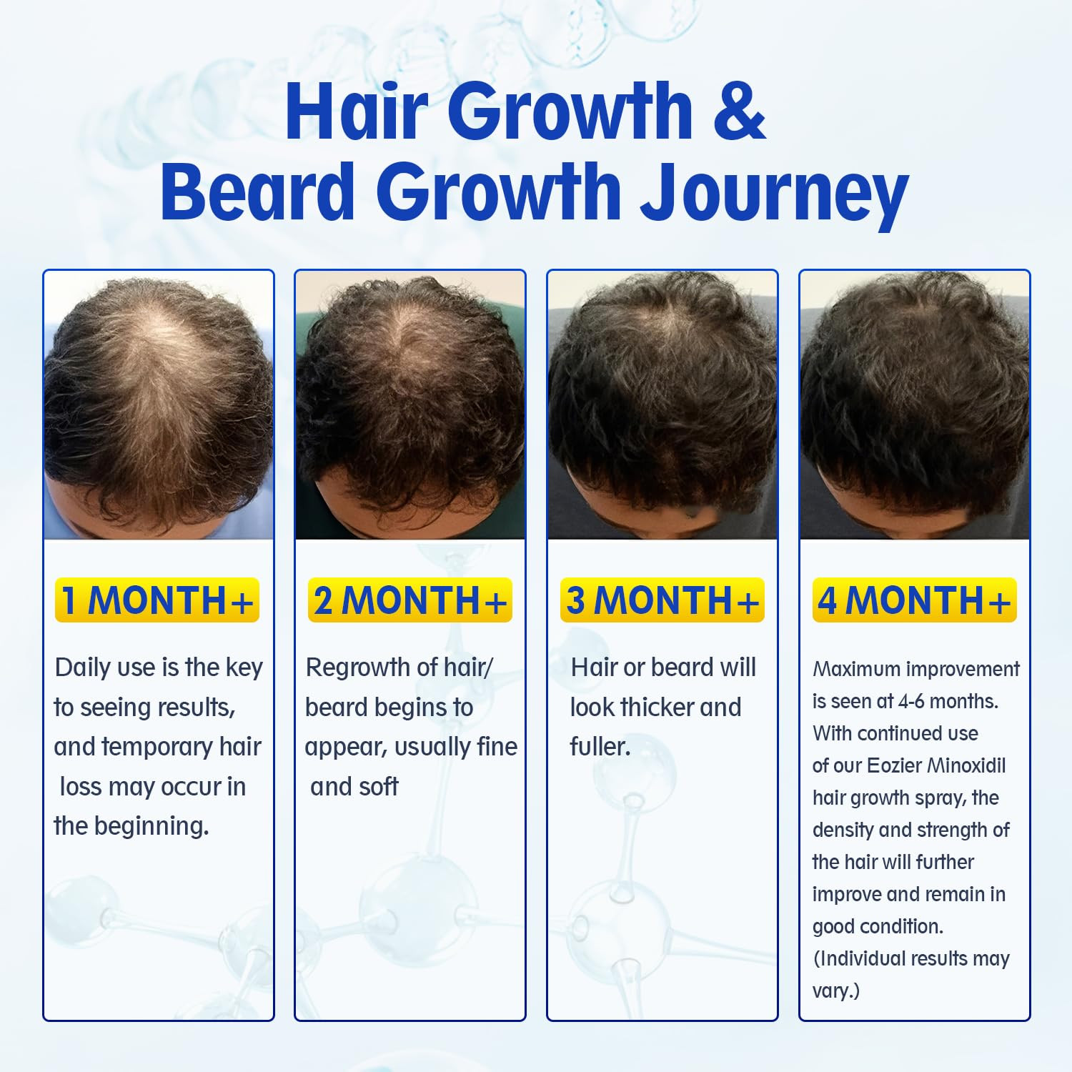 5% Minoxidil with Biotin, Hair Loss Treatments for Women Men Hair Regrowth Treat