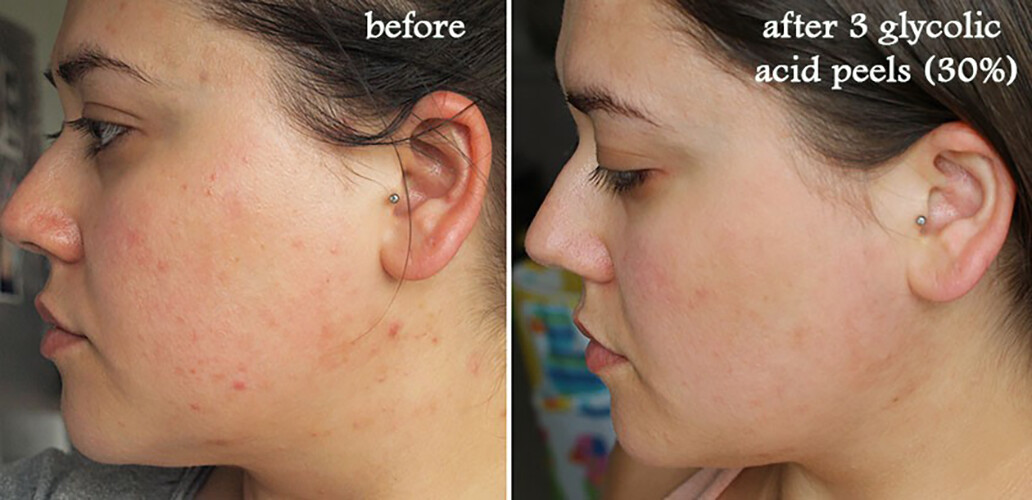 Glycolic Acid Face Peel Kit Medical Grade Pure Acne Scars Wrinkles Anti-Aging