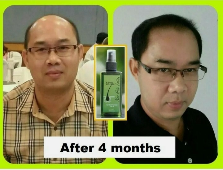2025 Neo Hair Lotion Hair loss treatment 100% Natural MFG : 22/01/2025