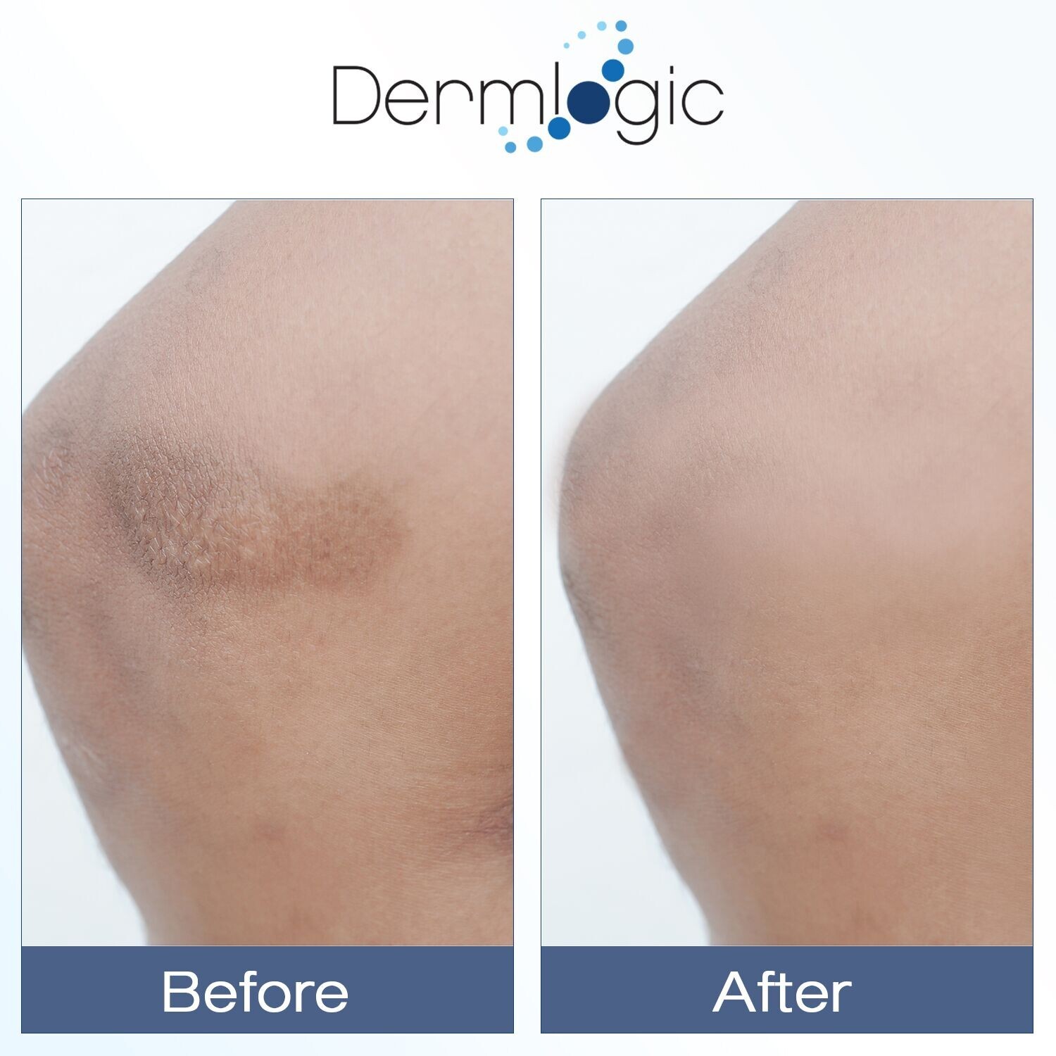 Vitamin K Cream – For Bruising, Spider Veins, Broken Capillaries, Dark Circles.