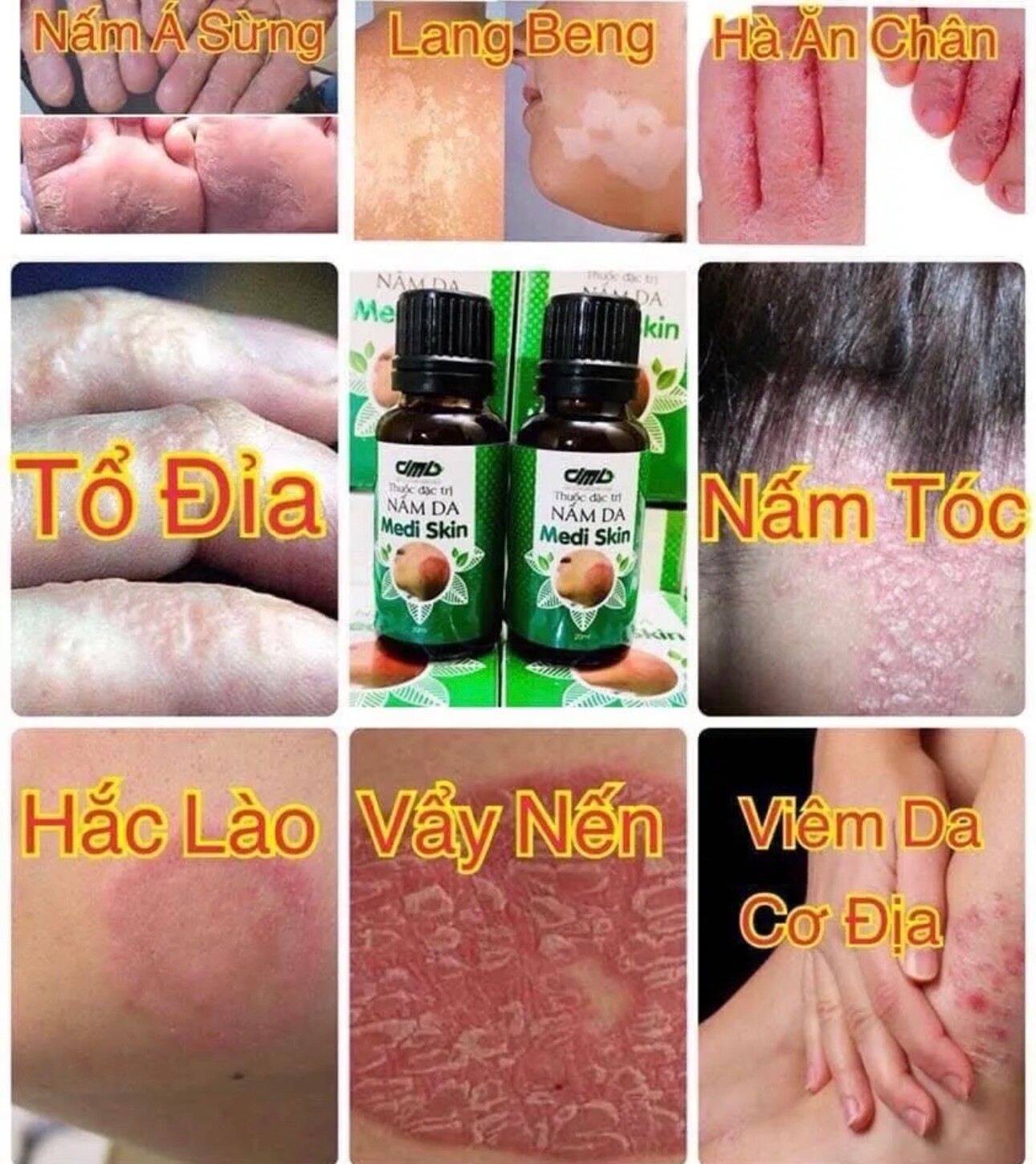 DMD- COMBO OF MEDI SKIN TREATMENT FOR PSORIASIS,ECZEMA.