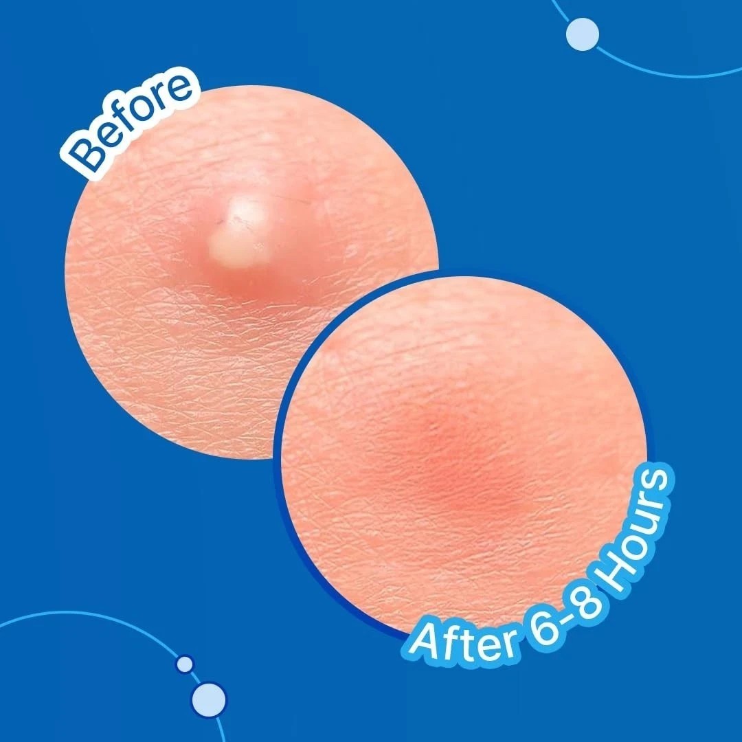 Sotrue Acne Pimple Patches Hydrocolloid For Face Active Acne 36 Waterproof Dots