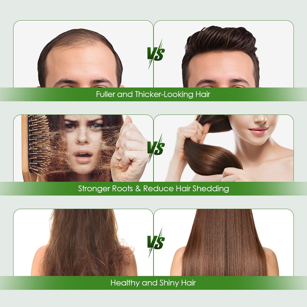 Microneedle Infusion Hair Regrowth System, Advanced Hair Growth Treatment, USA