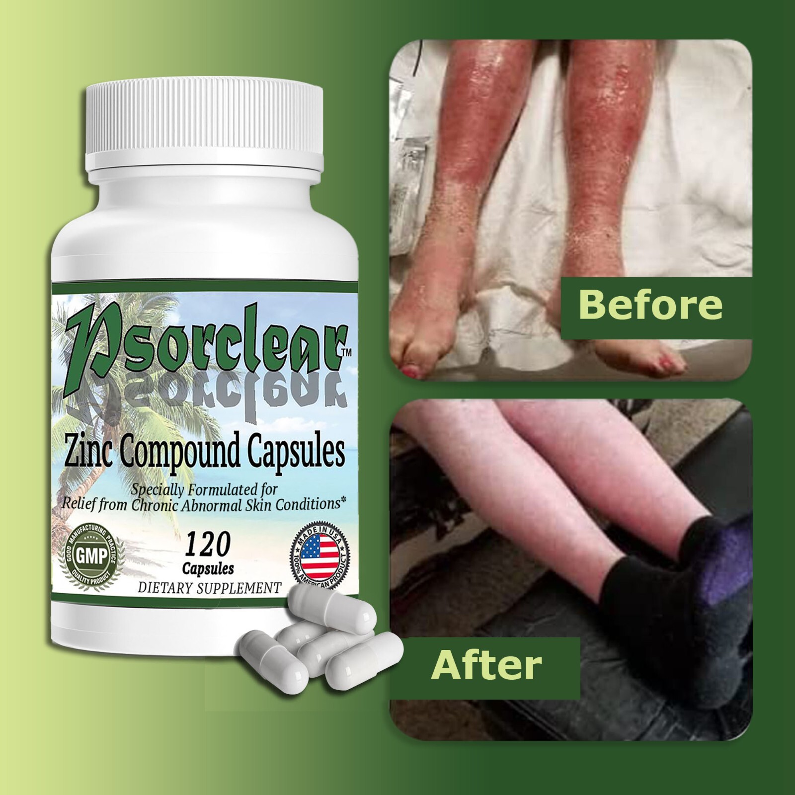 Psorclear – Proven Effective Treatment for Psoriasis & Eczema that REALLY WORKS!