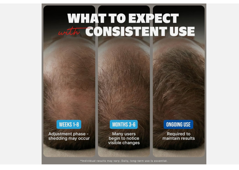Kirkland Minoxidil 5% Extra Strength Men 6 Month Supply Hair Regrowth EXP 08/27+