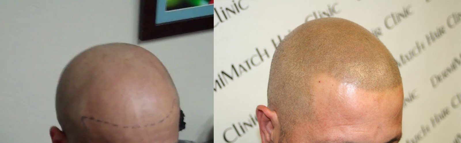 Pigment HD-C – Scalp Micropigmentation Pigment by DermMicro (0.5 oz)