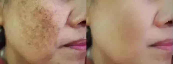 Wheezal Mel X Melasma Cream 25gm free shipping