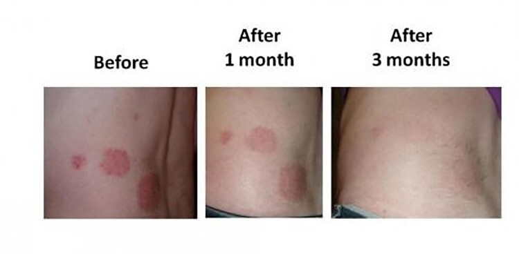 Intense Treatment Cream – Eczema Psoriasis Rosacea Dermatitis Shingles Rash -4oz