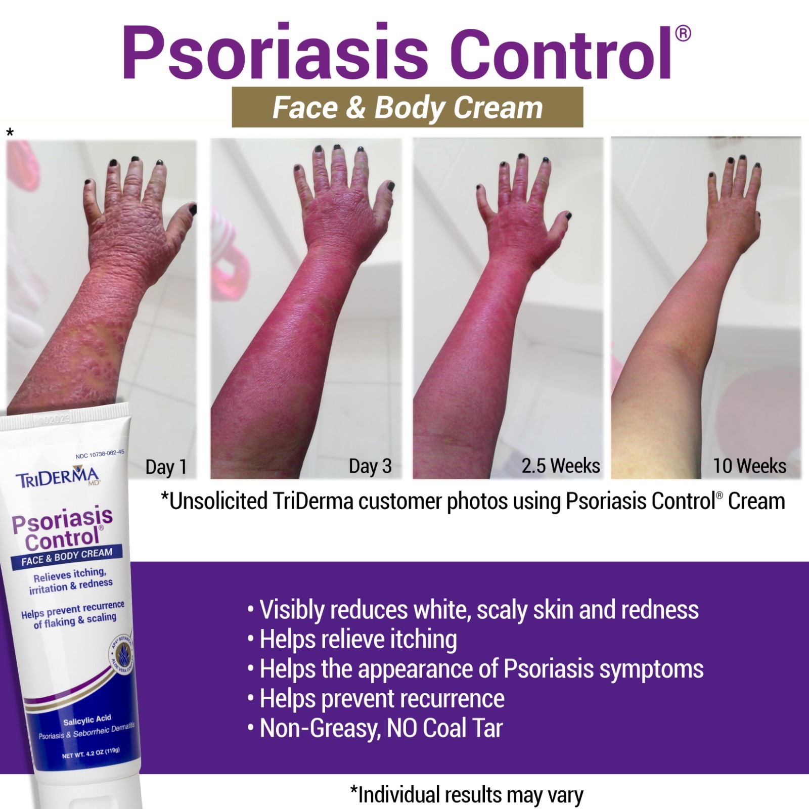 TriDerma Psoriasis Control Face & Body Cream – FSA Eligible, 4.2 oz – 4-Pack