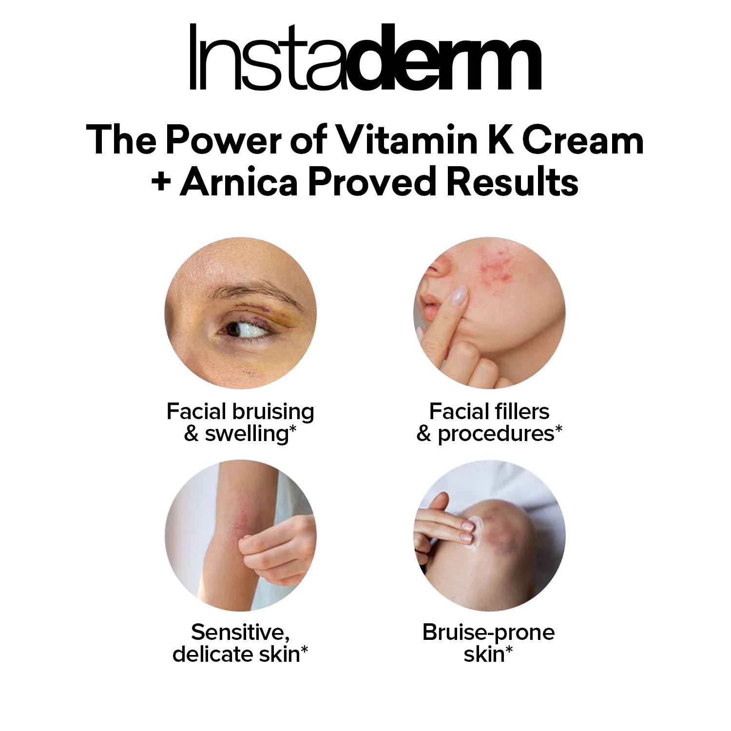 Vitamin K Cream-For Bruising, Spider Veins, Broken Capillaries, & Dark Circles.