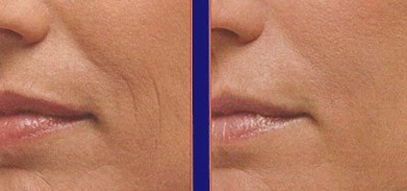 Peptide Collagen Serum AntiAging Wrinkle Cream-Matrixyl 3000 Hyaluronic Acid