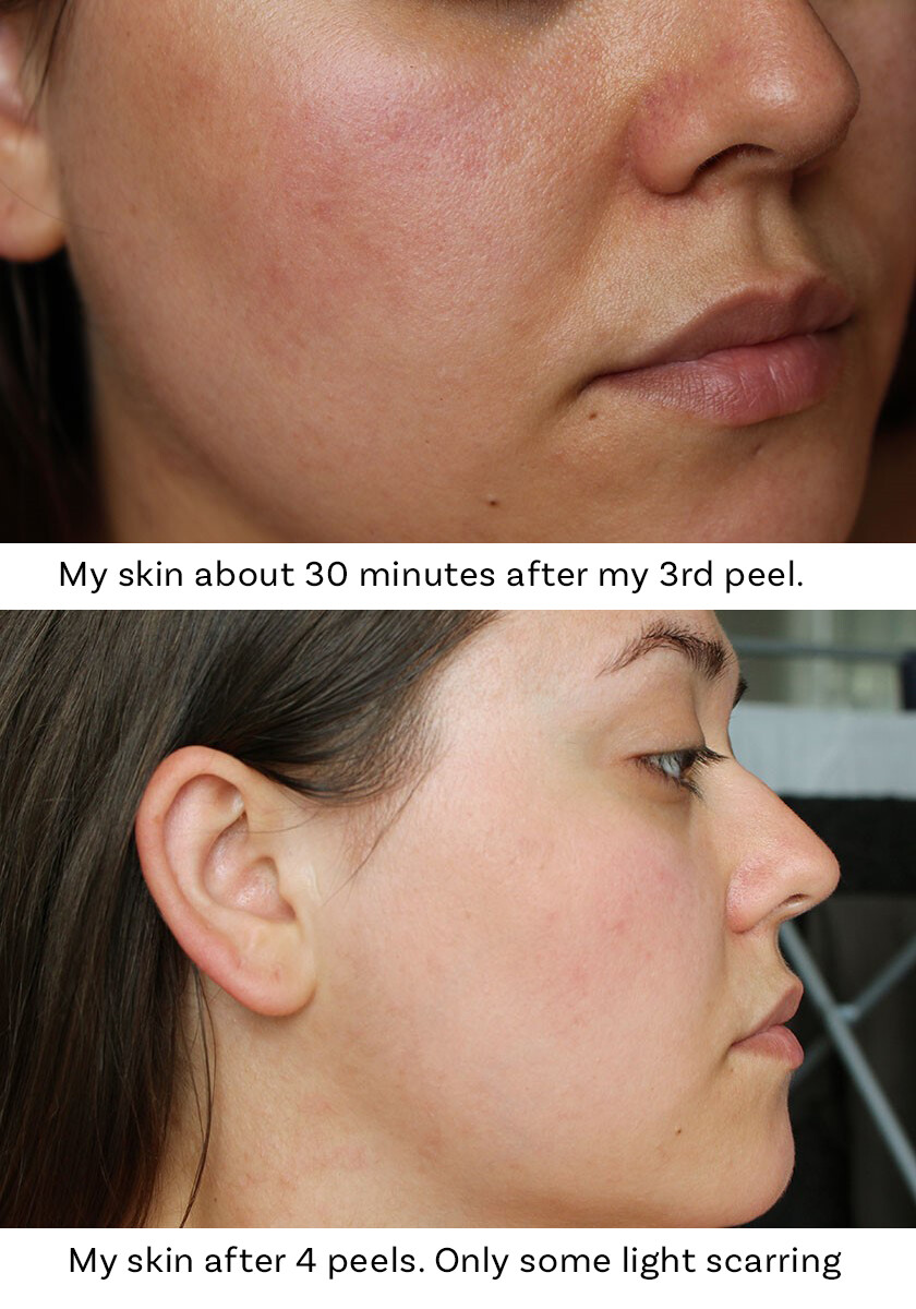 Glycolic Acid Face Peel Kit Medical Grade Pure Acne Scars Wrinkles Anti-Aging