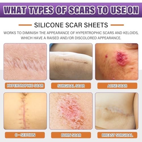 Silicone Scar Tape for Keloids Hypertrophic Scars 1.6in x 150in 3.8m Roll Kit