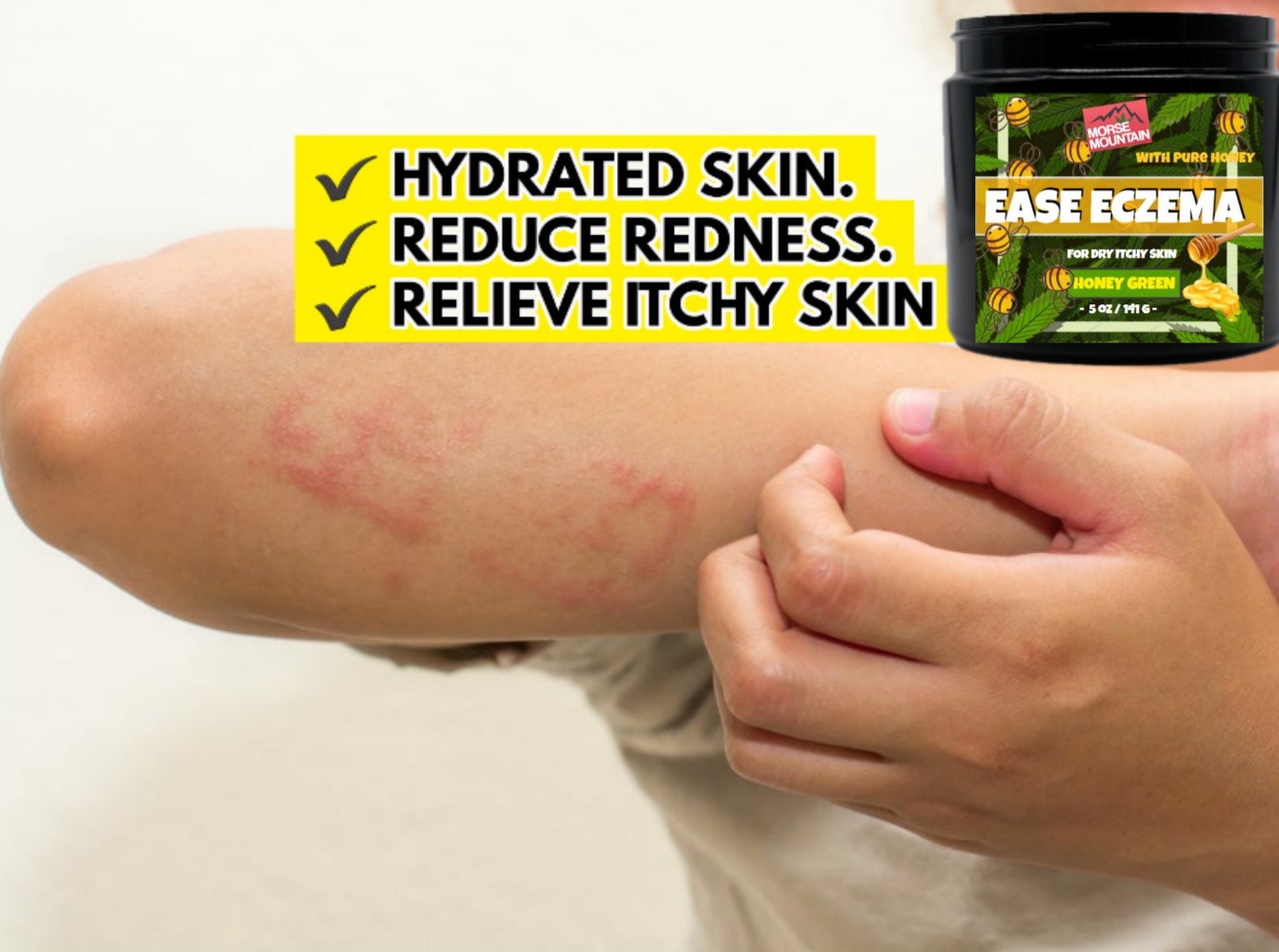 Eczema / Psoriasis Honey Ointment Cream Natural Dermatitis Treatment