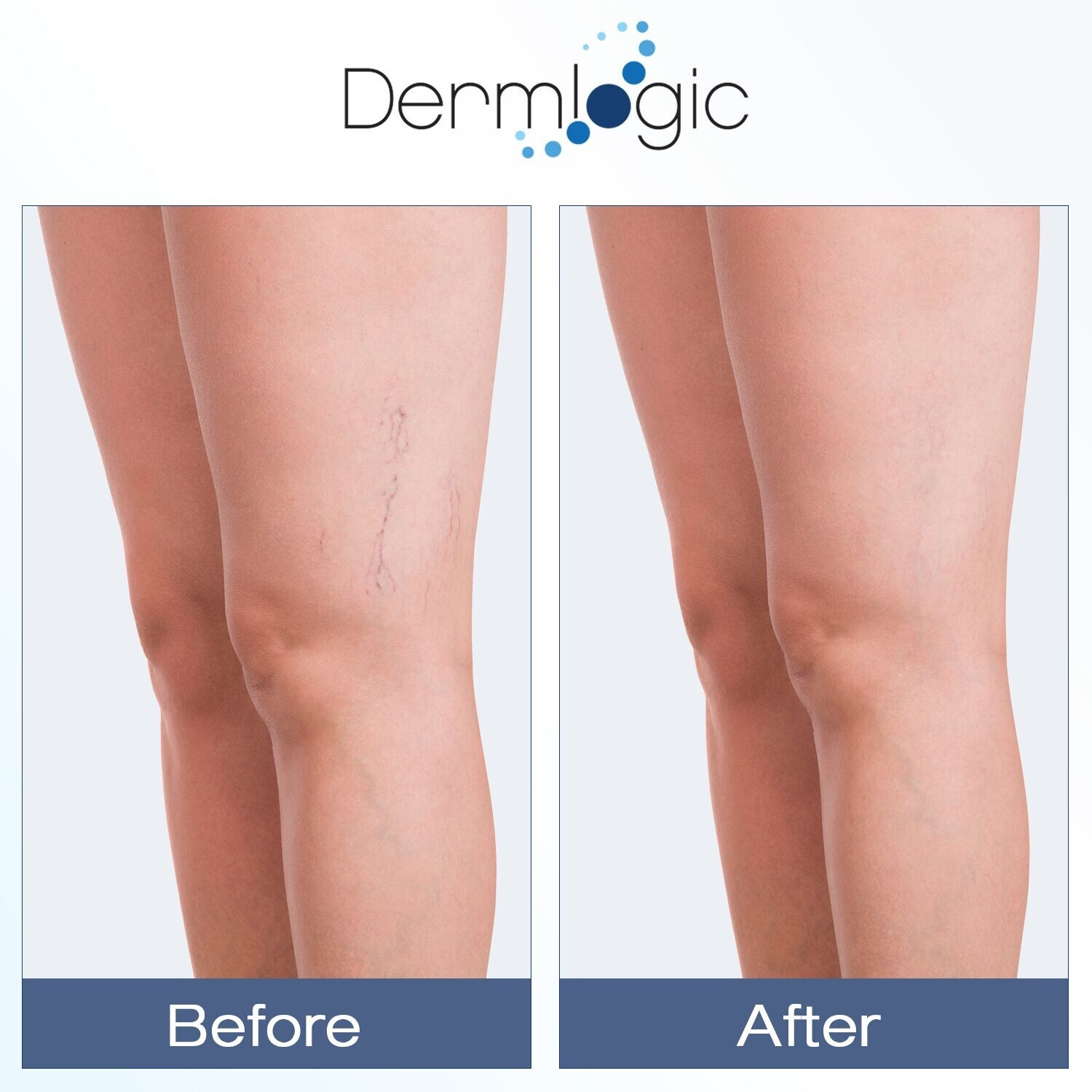 Vitamin K Cream – For Bruising, Spider Veins, Broken Capillaries, Dark Circles.