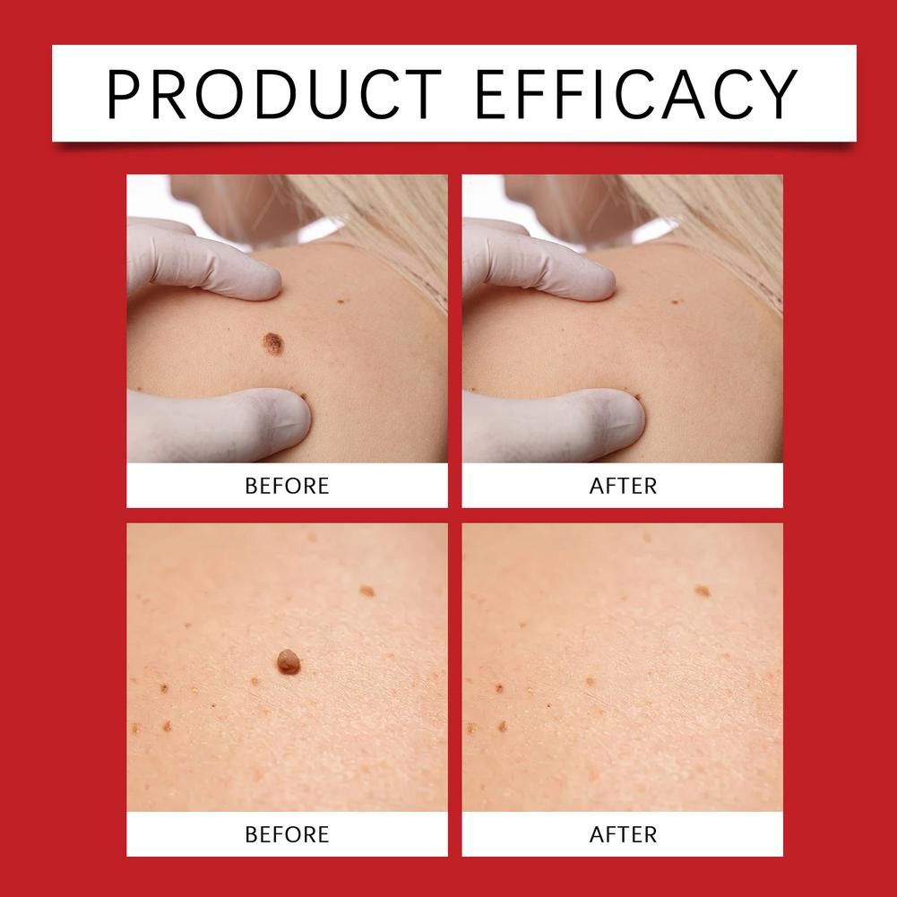 1-5 *Box MICRONEEDLE BOTANIC Skin Tag & Acne Patch Skin Tag Remover Patches