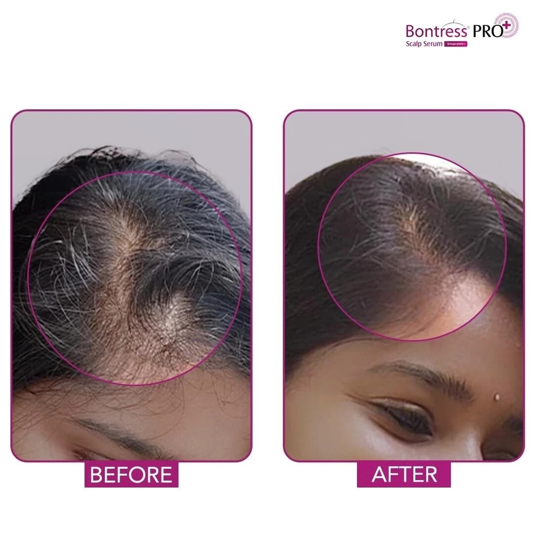 Bontress PRO+ Scalp Serum with Redensyl Anagain for Hair Growth & Hair Fall 30ml
