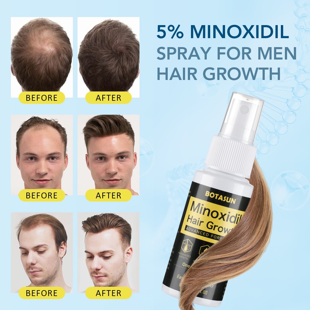 3 Pack 5% Minoxidil Hair Growth Serum Spray for Men Hair Regrowth 3 Month Supply