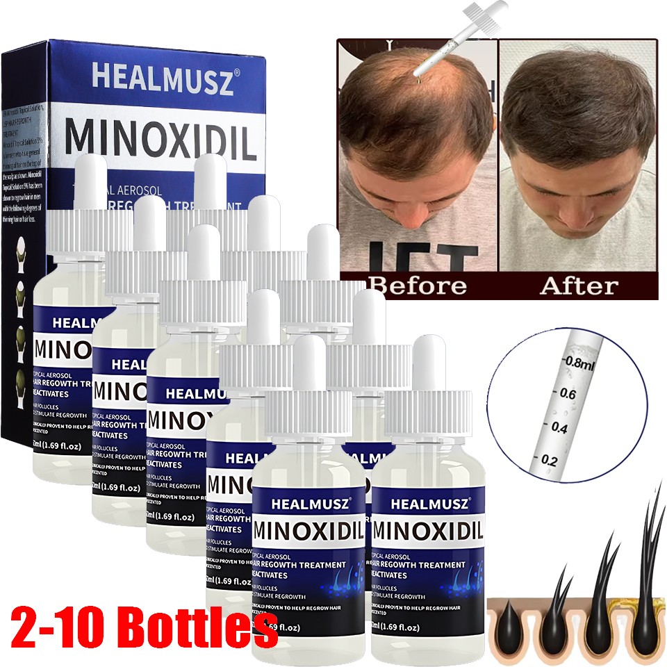 Minoxidil 5% Hair Regrowth Solution Extra Strength Men Women 2-10 Months Supply