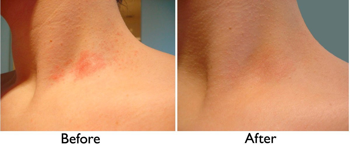 Intense Treatment Cream – Eczema Psoriasis Rosacea Dermatitis Shingles Rash -4oz