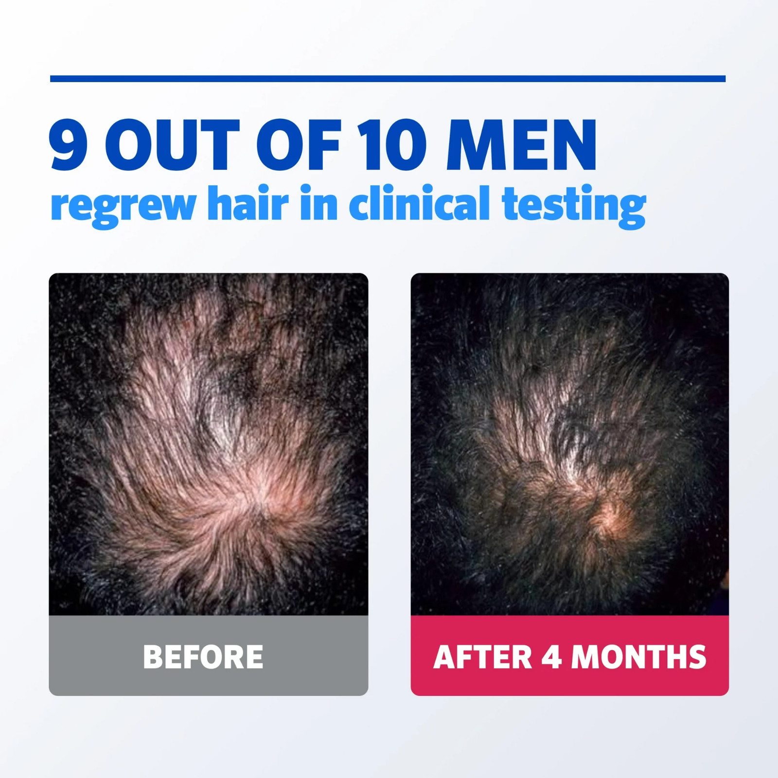 ✳️ Kirkland Minoxidil 5% Hair Regrowth Treatment AUTHENTIC Exp 03/2025✳️