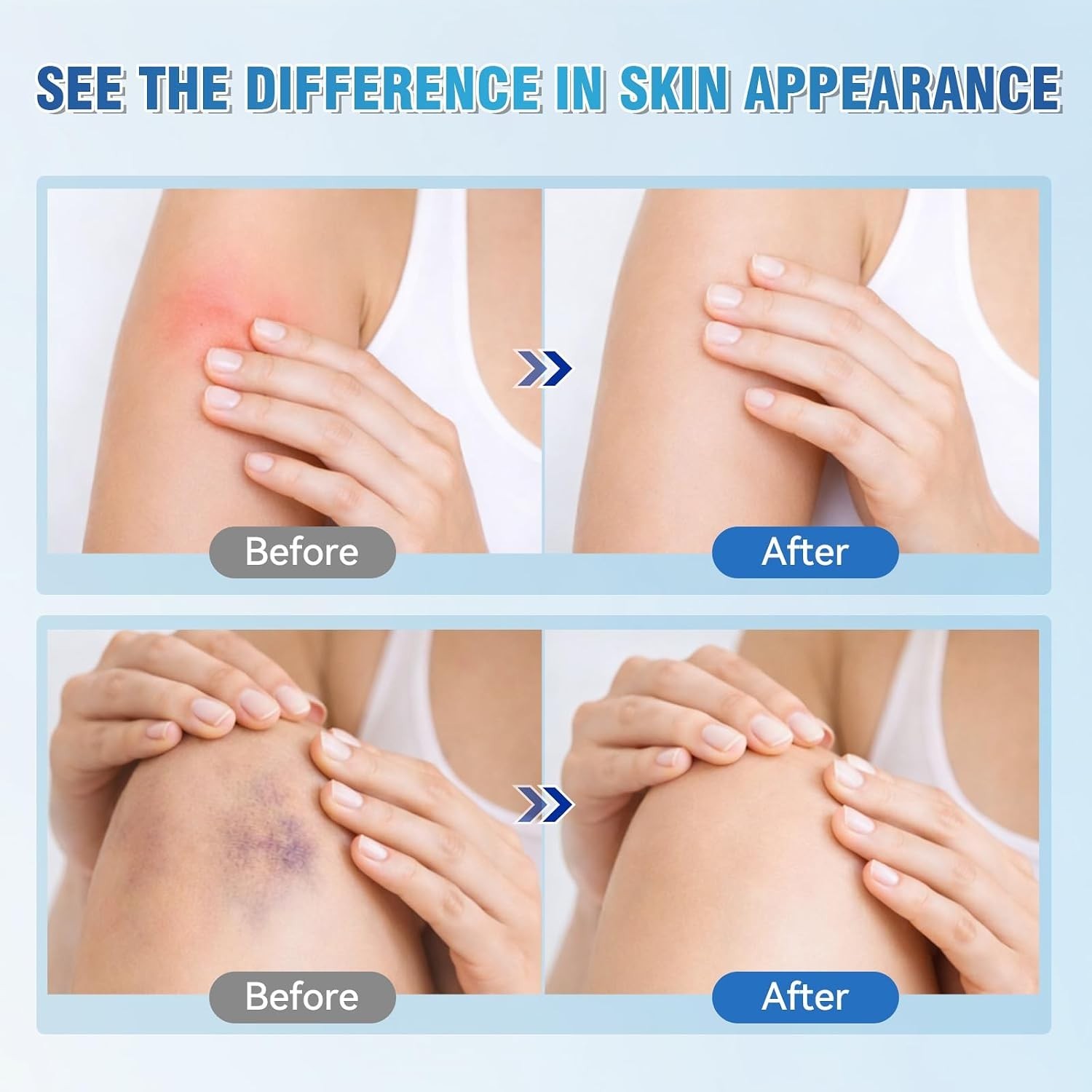 Arnica Bruise Repair Cream with Vitamin K C E Skin Renewal for Seniors Thin Skin