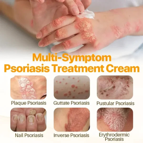 1 Pack Crema Para Dermatitis Eczema Psoriasis Para Comezon Picazon Ronchas En La
