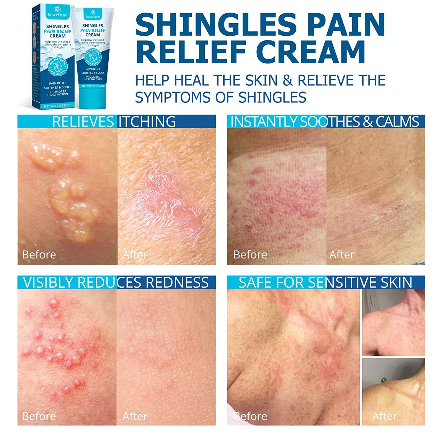 Shingles Treatment, Anti Itch Cream Extra Strength Shingles Pain Relief Cream