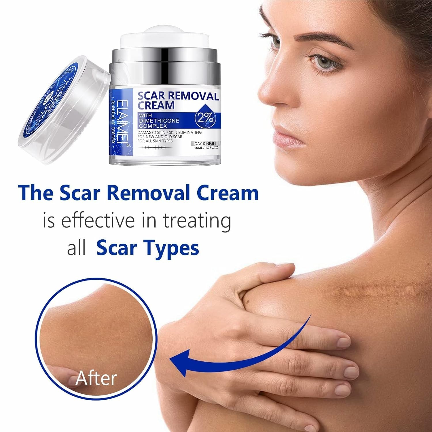 Ungüento Crema Avanzada Para Eliminar Cicatrices Quirúrgicas Quemaduras y Acné