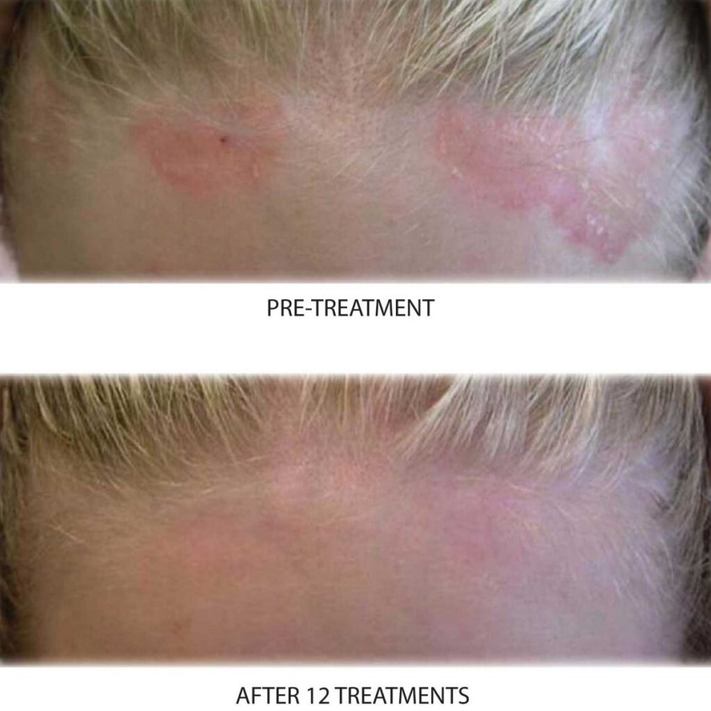 Intense Treatment Cream – Eczema Psoriasis Rosacea Dermatitis Shingles Rash -4oz