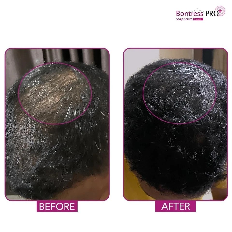 Bontress PRO+ Scalp Serum 60ml for Hair Growth and Hair Fall Control