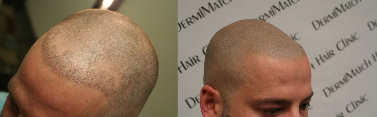 Pigment HD-C – Scalp Micropigmentation Pigment by DermMicro (0.5 oz)