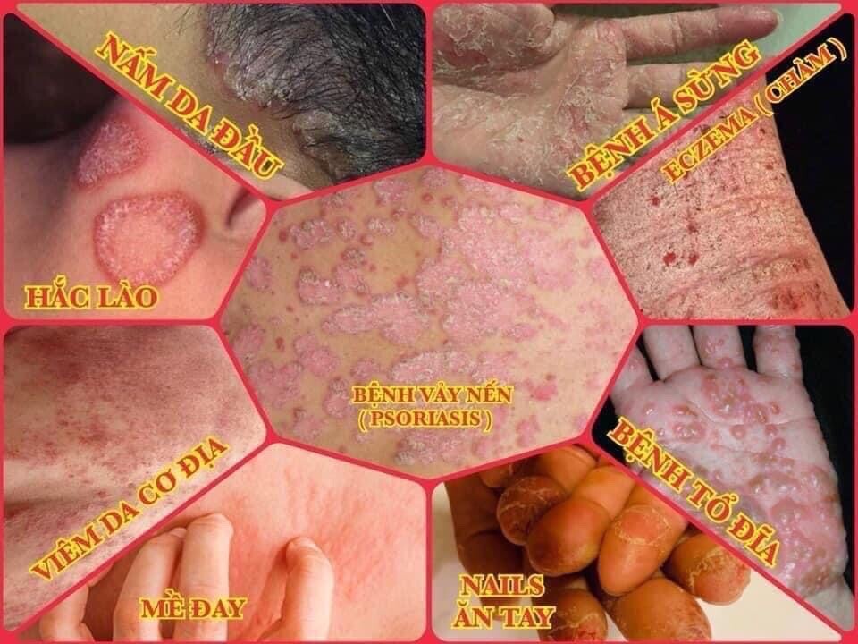DMD- COMBO OF MEDI SKIN TREATMENT FOR PSORIASIS,ECZEMA.