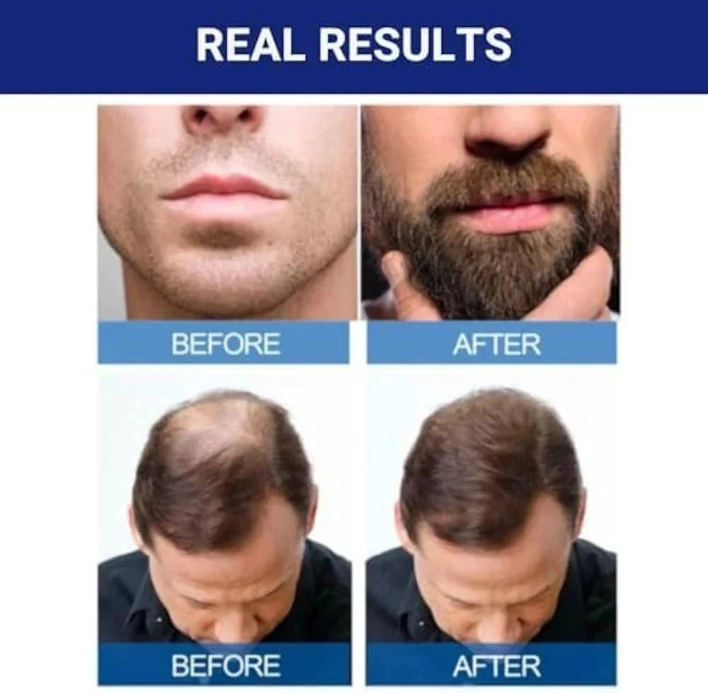 Kirkland Minoxidil 5% Extra Strength Men 6 Month Supply Hair Regrowth
