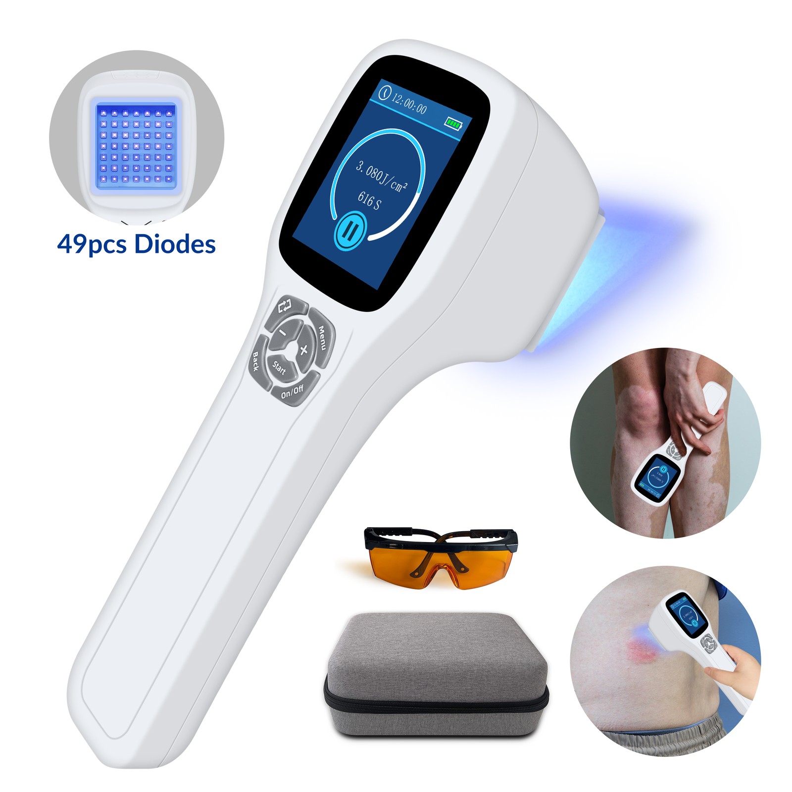308nm Ultraviolet Light Therapy Lamp Handheld UVB Light for Body Skin Treatment