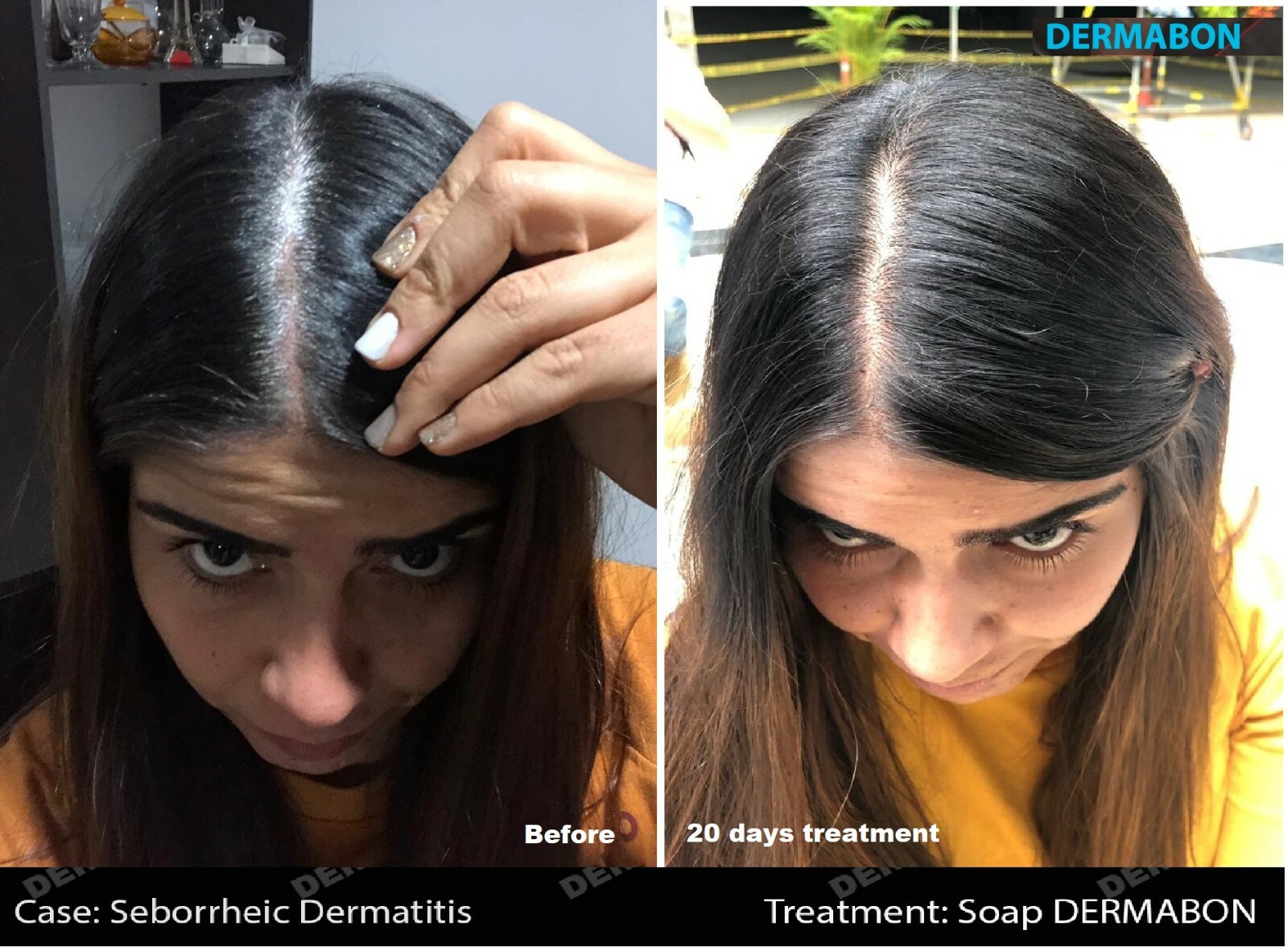 Dandruff Psoriasis Seborrheic Dermatitis 3 Pack Dermabon natural