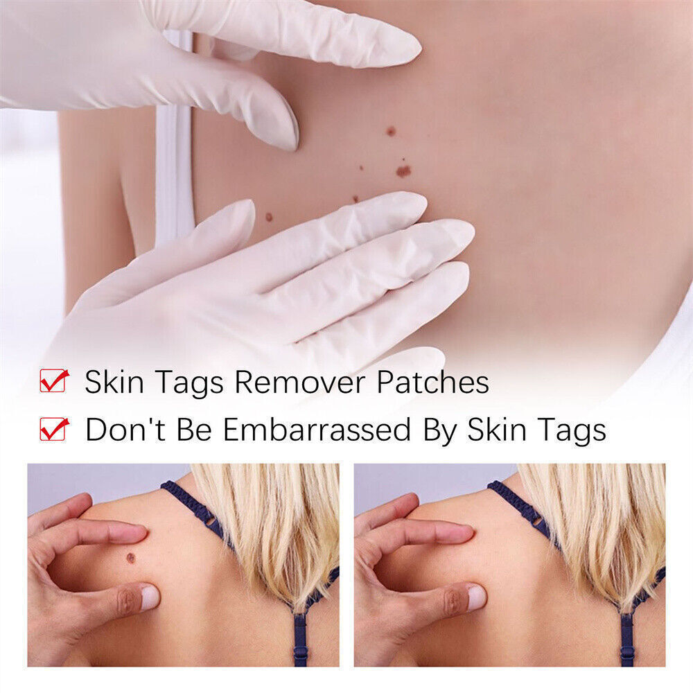 “FINAL SAL” Skin Tags & Moles Removal Quick Safe Remover Restore Skin 3ml US