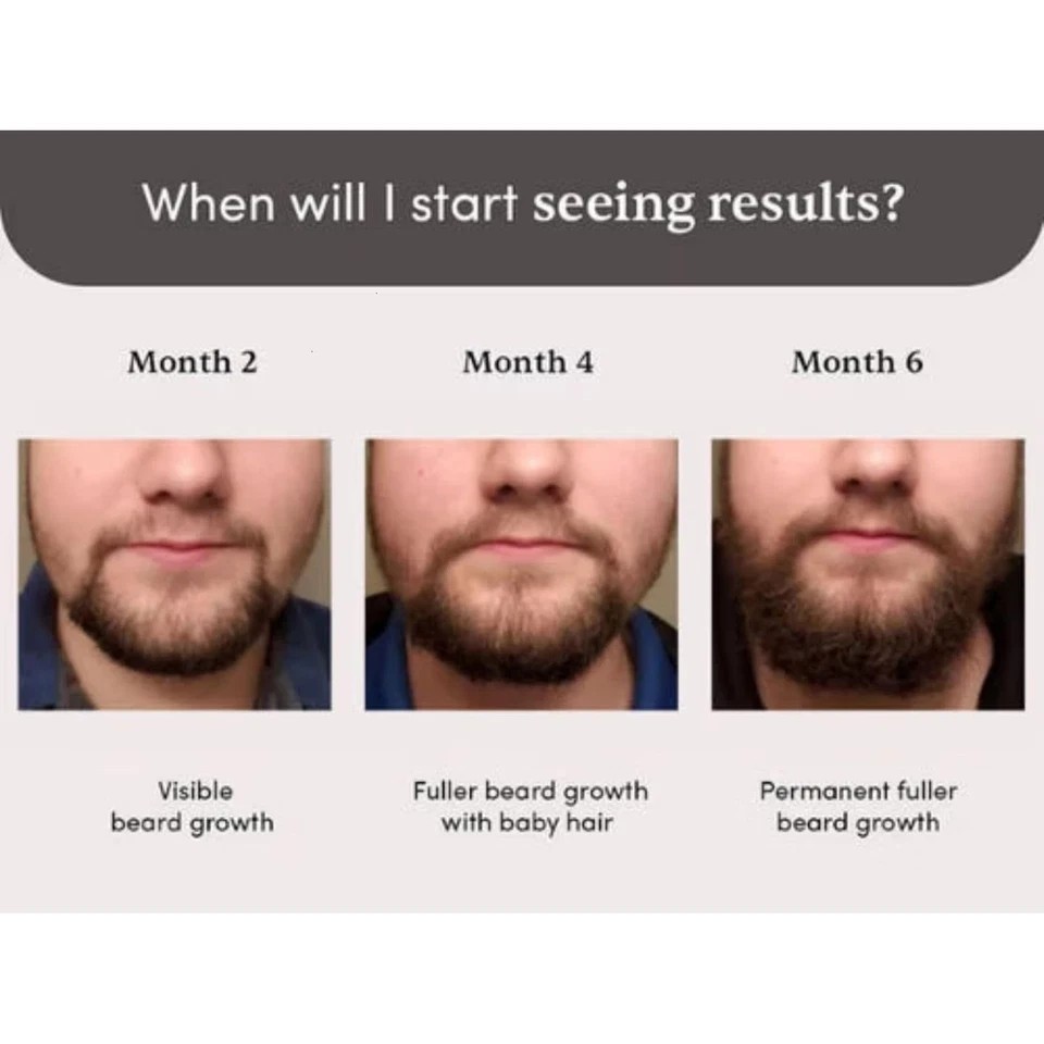 Beardmax Hair Growth Serum | Activates Beard Follicles | Solves Uneven & Patchy