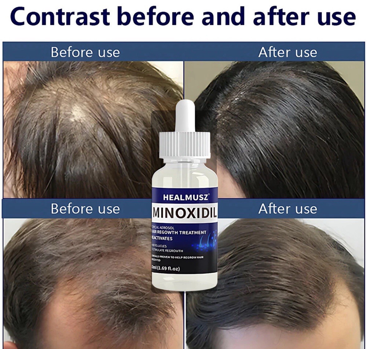 14 Pack Minoxidil 5% Extra Strength Men Hair Regrowth Treatment 14 Month Supply
