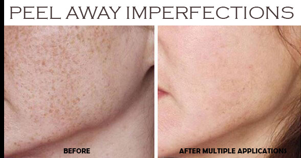 80% Gly-lactic Glycolic and Lactic Acid Skin Chemical Face Peel for Exfoliation