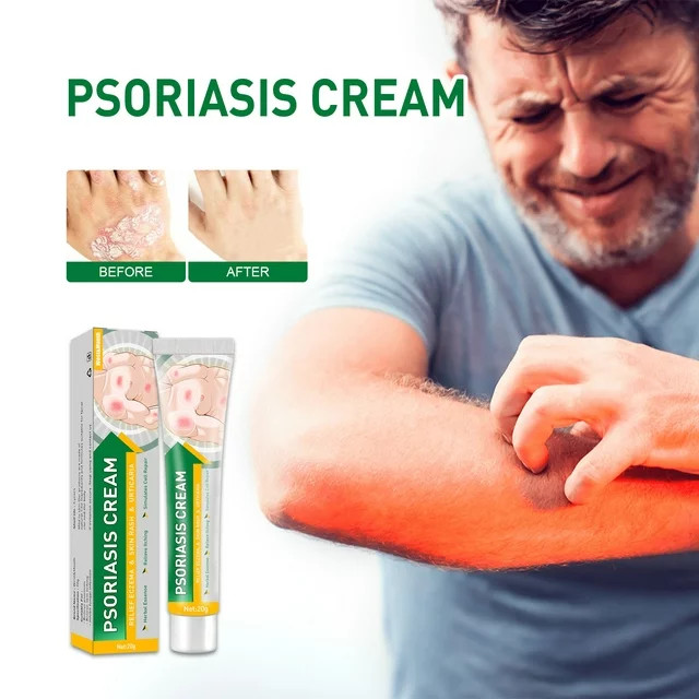 Psoriasis Cream Eczema Ointment Skin Treatment Scalp Hand Foot
