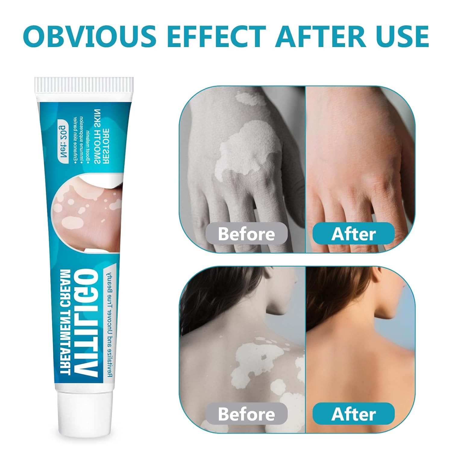 Natural Vitiligo Cream, Improves White Spots & Skin Pigmentation