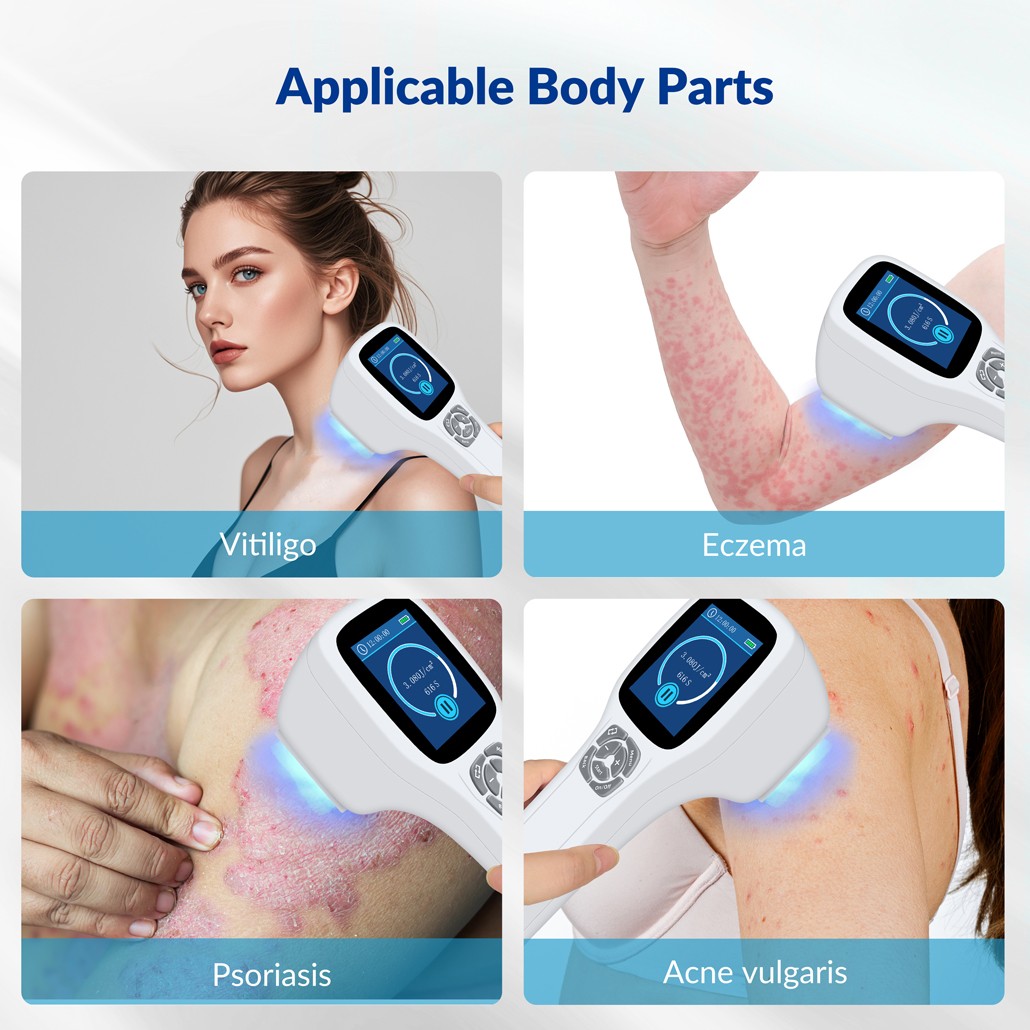 Handheld 308nm UVB Light Phototherapy Device Portable for Eczema Skin Therapy