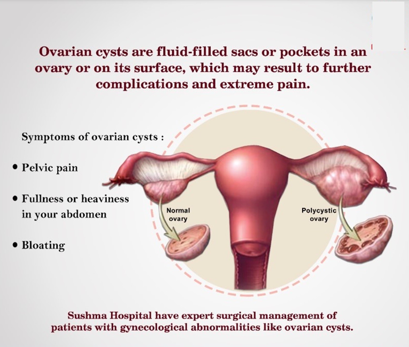 OVARIAN CYST FREE REMOVAL 4 ME – TO TREAT & PREVENT Made in USA – 120 capsules