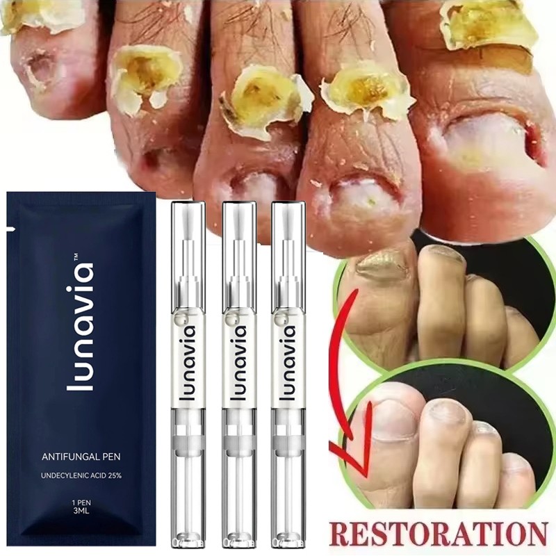 15 Pack Lunavia Antifungal Pen, 25% Undecylenic Acid – Toenail Fungus Treatment